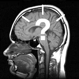 MRI Amnesia